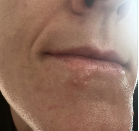 Oral lesion medical example